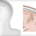 Se podría «tratar» el autismo o esquizofrenia implantando un chip cerebral