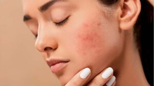 Lee más sobre el artículo ¿Quieres cuidar mejor tu piel? Inscríbete en este curso gratuito de dermatología